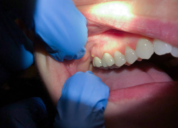 Best Emergency Treatment for Dental Infections or Abscesses in Tok, AK